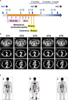 Hilar/mediastinal and cutaneous drug-induced sarcoidosis-like reaction associated with immune checkpoint inhibitors in metastatic colorectal cancer: a case report